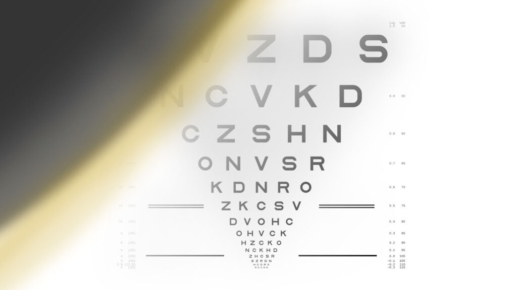 LogMAR chart after a retinal detachment. Large dark shadow and blurring on the left-hand side, with minor white/yellow flaring at edge of shadow.