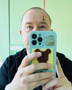 Stewart taking a selfie of his left eye pre-surgery, with a black arrow pointing down above it.