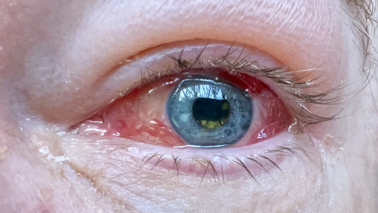 Extreme close-up of Stewart's left eye showing redness and dilated pupil.