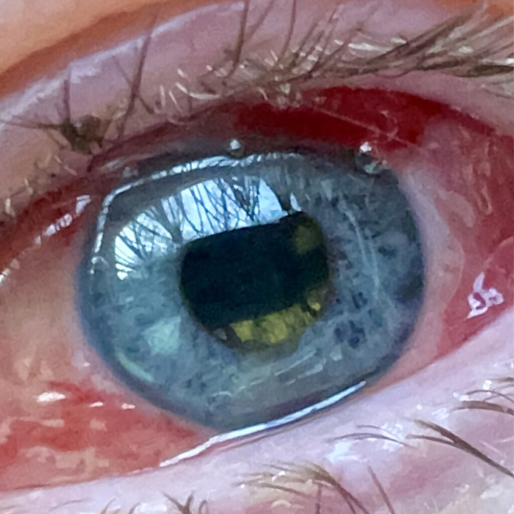 Extreme close-up of my left eye, with blue iris and reddening of the sclera.